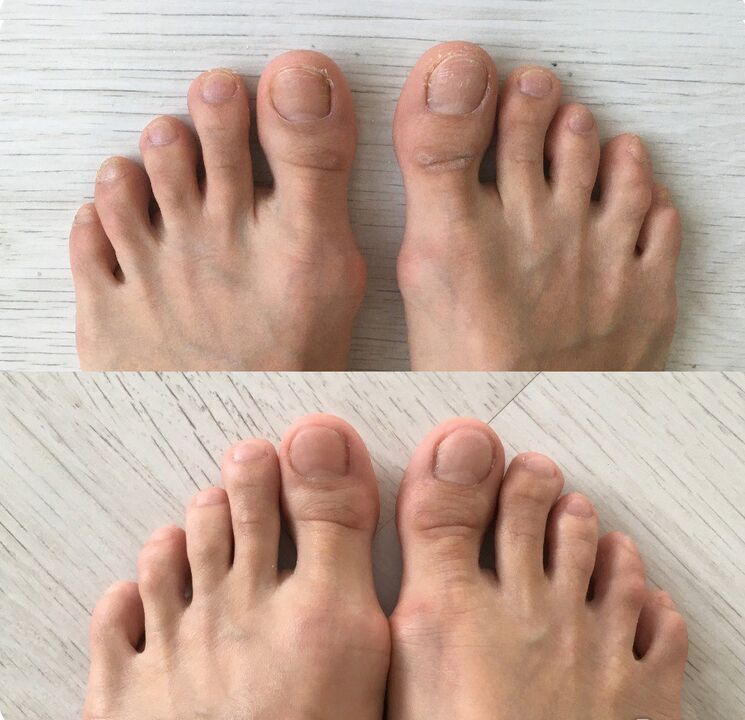 prima e dopo l'uso di Foot Tropper Spray